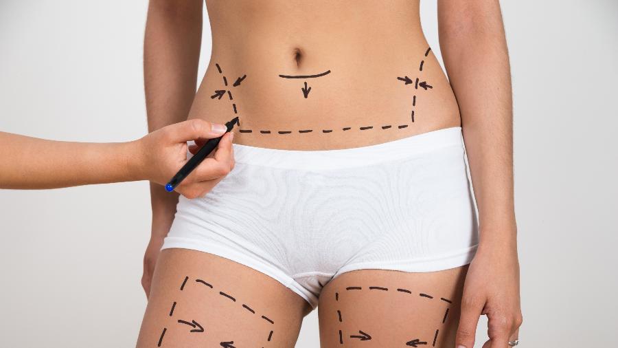 Are You Eligible to Get Liposuction?